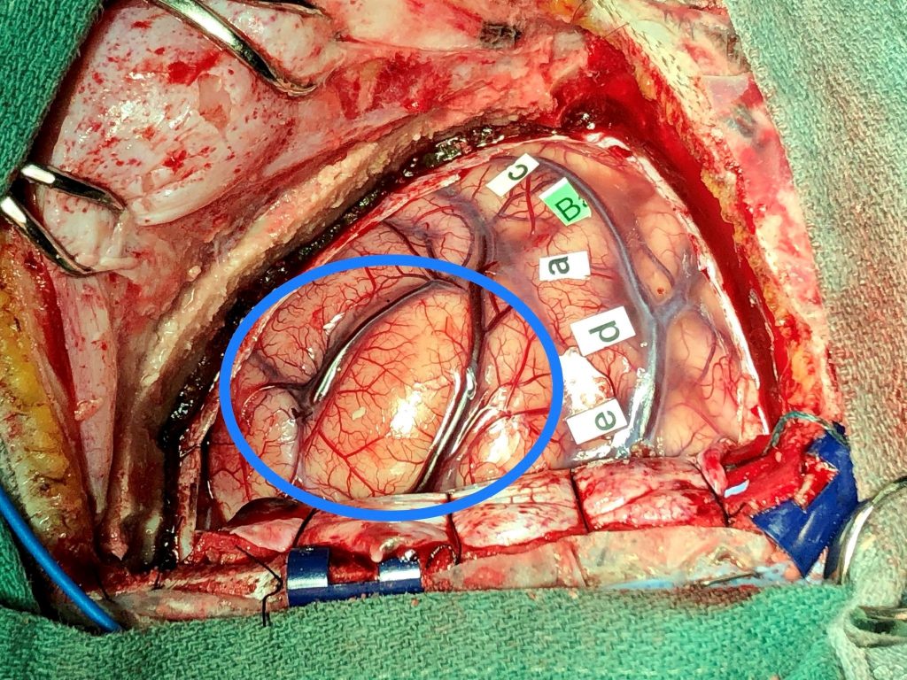 Julie's brain during surgery with the motor functions labelled and the tumour circled