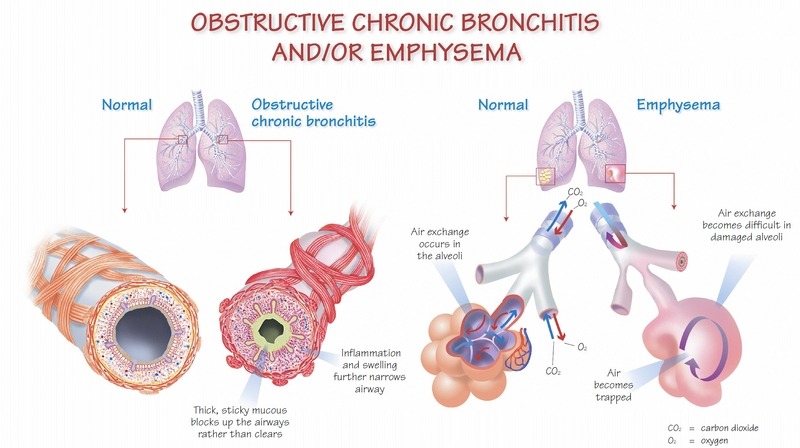 a graphic depicting the difference between emphysema and chronic bronchitis