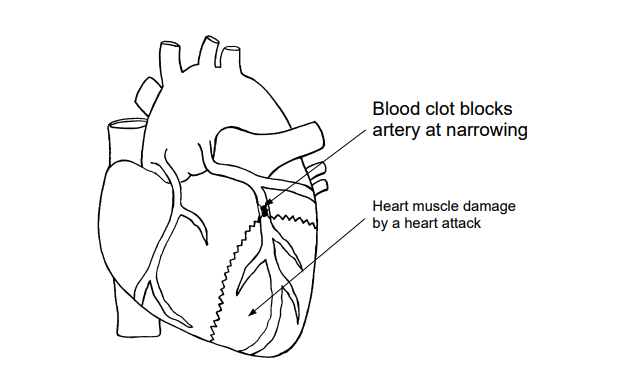 Heart diagram showing blood clots blocking the artery
